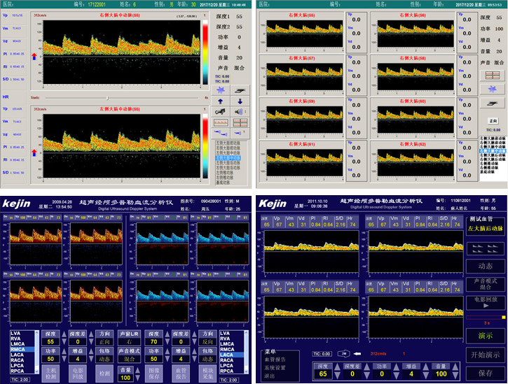 經顱多普勒檢查和頸動脈彩超有什么區(qū)別